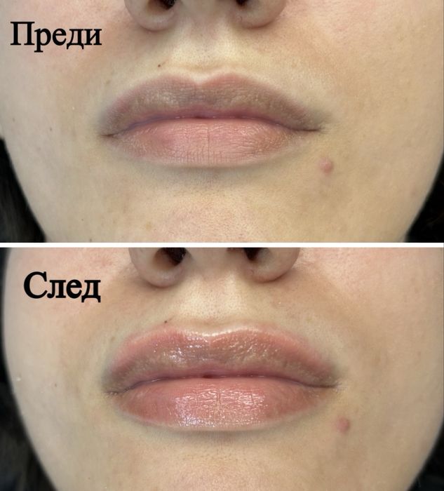 Процедура Hydra lips (за устни)