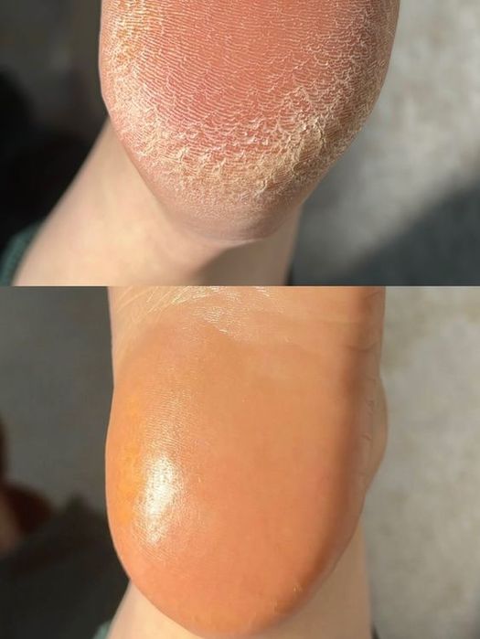 Ичига усган тирнок,Подолог хизмати