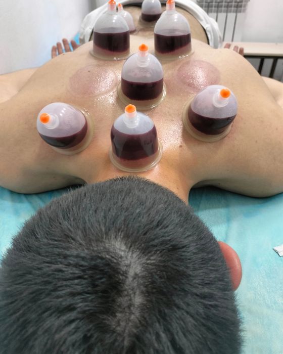 тиббий зулуклар медицинский пиявки гирудотерапия