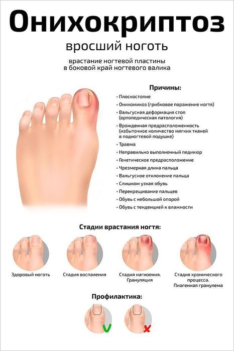 Титановая нить, исправление вросших ногтей.