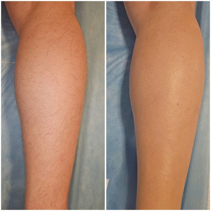 Epilare femei și bărbați, tratament cu parafina mâini și picioare