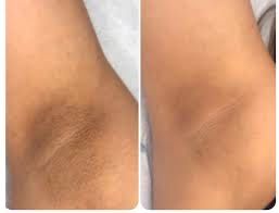 Интимное отбеливание