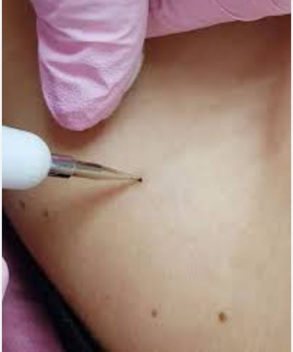 Удаление папиллом и бородавок