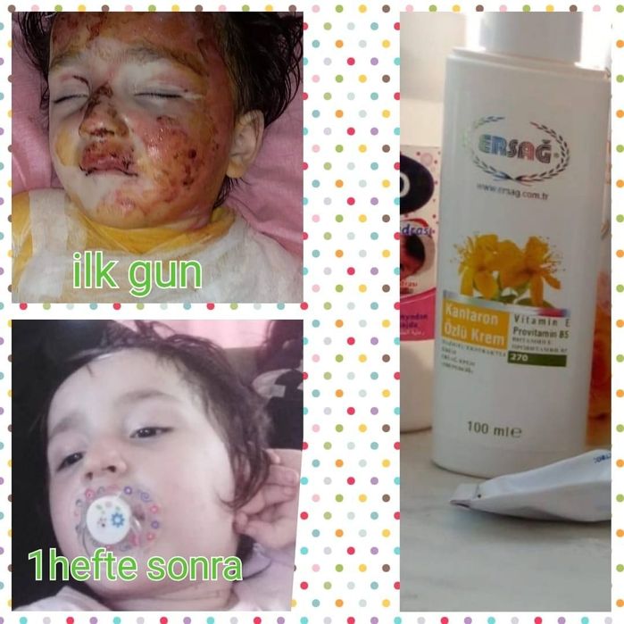 Ерсаг зверовой крем тыртик шрам куйгеннен кейн жагилад