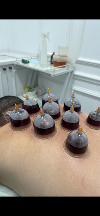 Хиджама 7000тг в подарок мануальная терапия