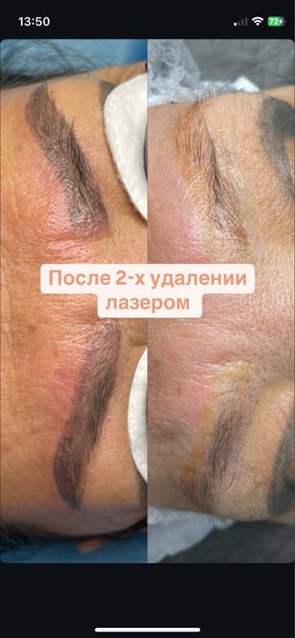 Удаление тату и татуажа