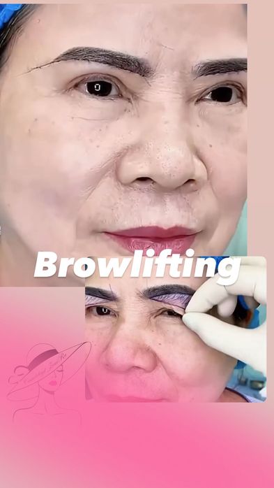 Блефаропластика Броулифтинг