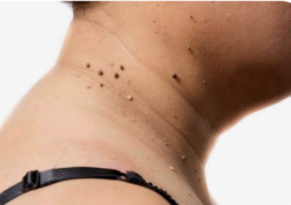 Удаление папиллом. Papilomalarni yùqotish