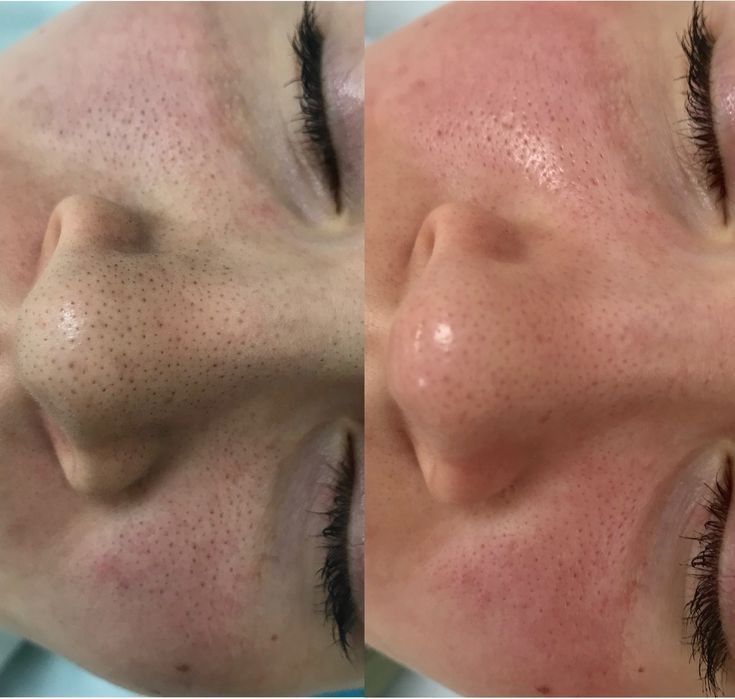 Чистка лица 9 этапная 9900тг