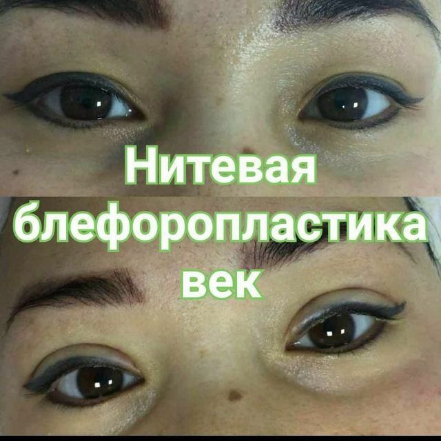 Блефаропластика верхних и нижних век