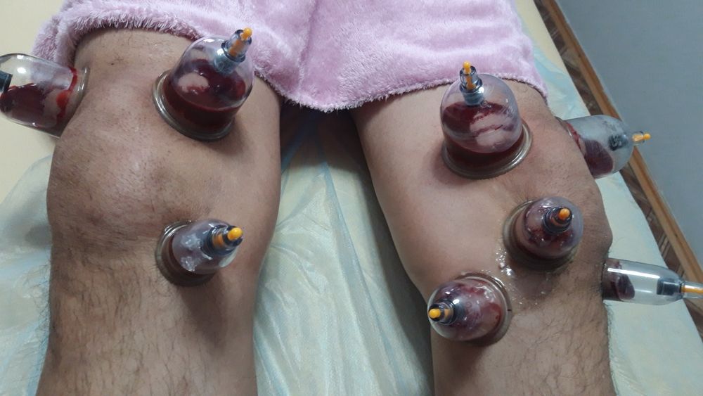 Хиджама. Шертпе. Пиявки