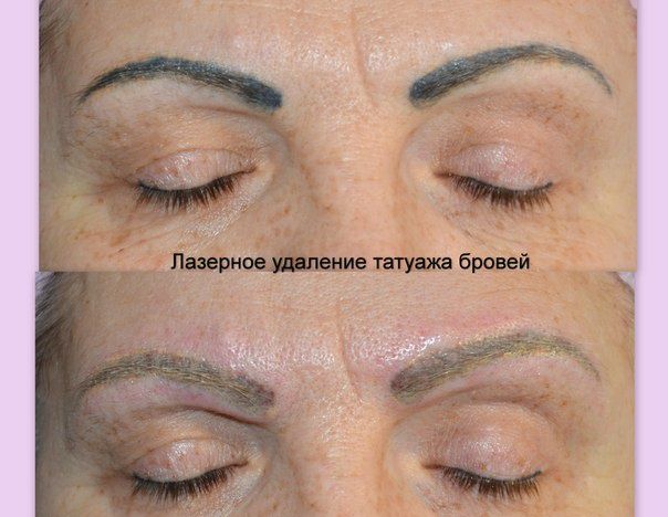 Как удалить татуаж бровей в домашних Как удалить татуаж бровей в домашних