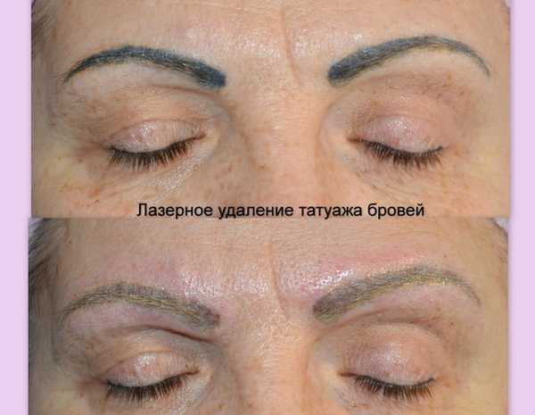 Выведение перманентного макияжа бровей области - Перманентный макияж / татуаж в Алматы - OLX.kz