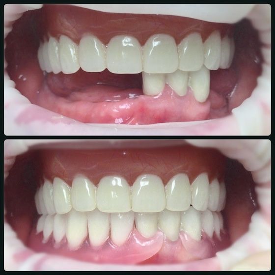 Съёмные зубные протезы