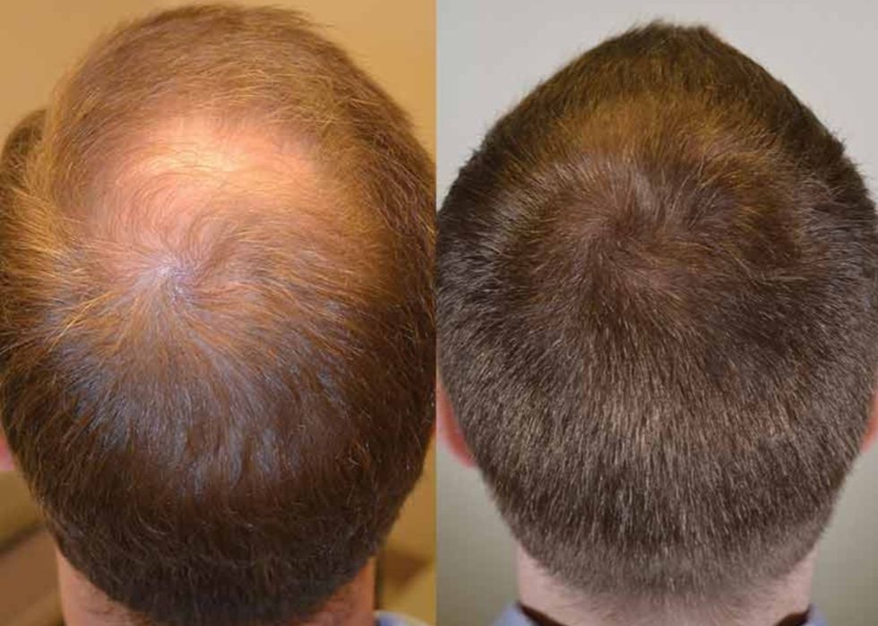 Трихопигментация волос