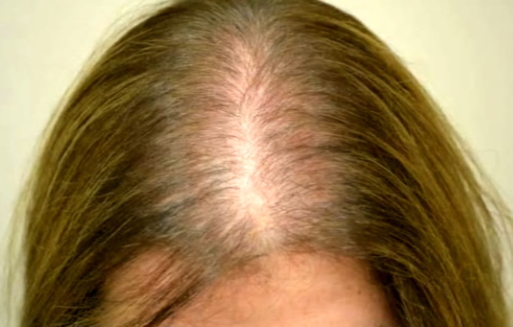 Plazmalifting,yuzga va soch tùkilishiga, Плазмалифтинг