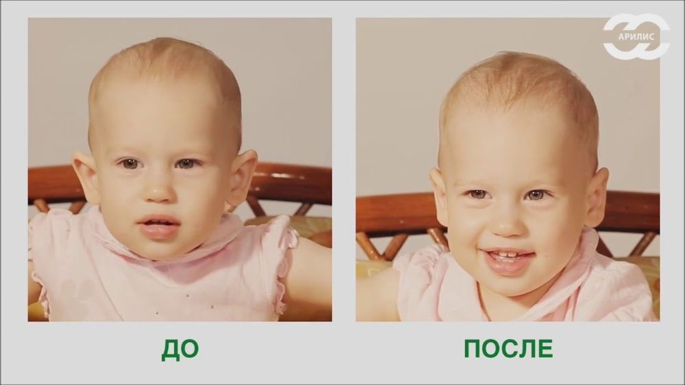 корректоры для ушей у новорожденных и у взрослых исправление форм