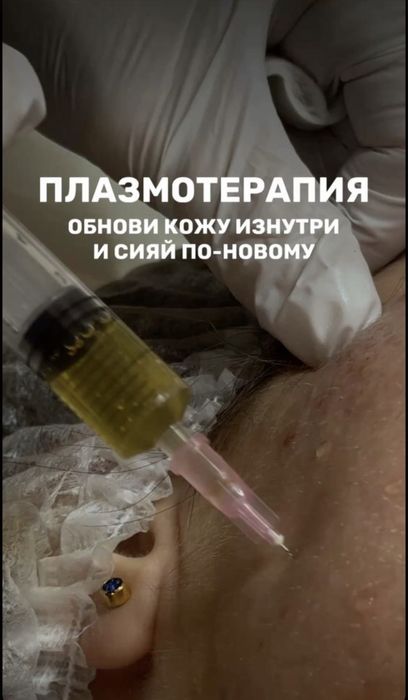 Плазмолифтинг - 7990