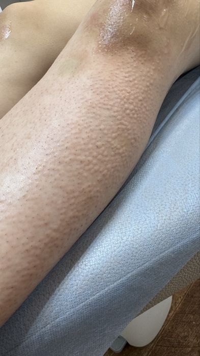 Лазерная эпиляция