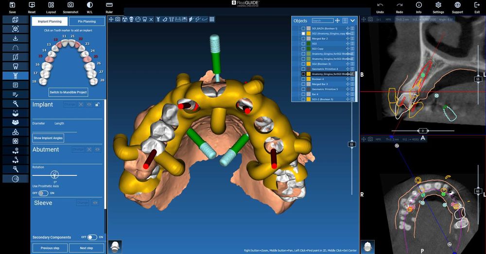 Realguide 5.4.2 + ImplantStation 5.3.2 + BlueSkyPlan + ImplantStudio