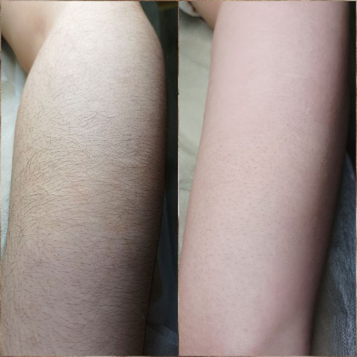 Профессиональная депиляция шугаринг, полимерный воск