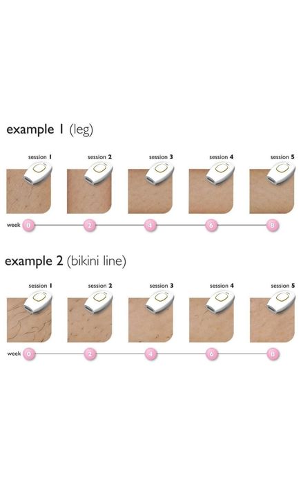 Лазерен епилатор LXNZUHN, подходящо за мъже и жени.