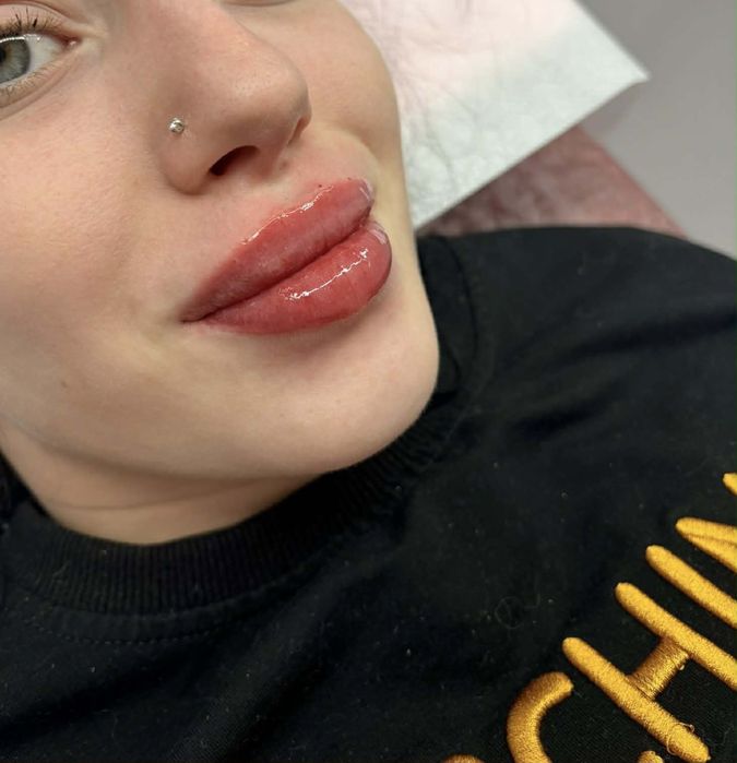 400 lei Buze hialuron pen 1 ml revolax