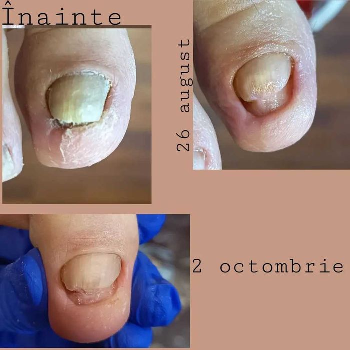 Pedichiură medicală Târgu Mureș