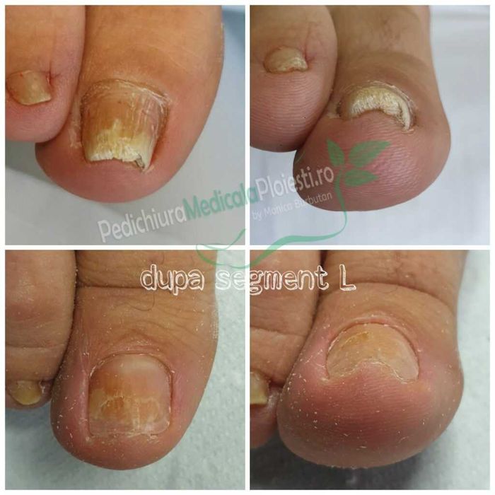 Pedichiura medicala/ Corectie unghii incarnate/ unghii dureroase