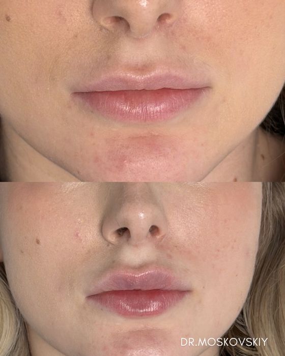 Увеличение губ|Алмата АКЦИЯ