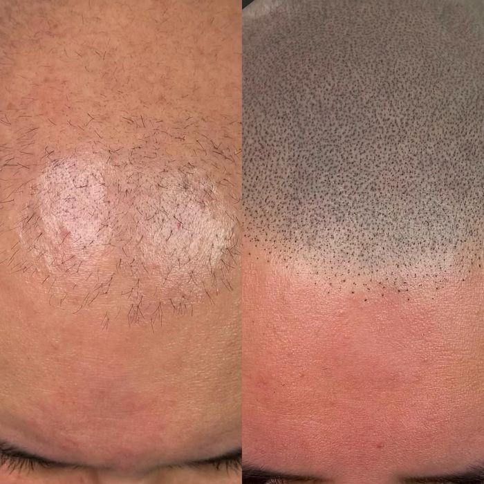 Micropigmentare scalp tricopigmentare efect indesire par alopecie SMP