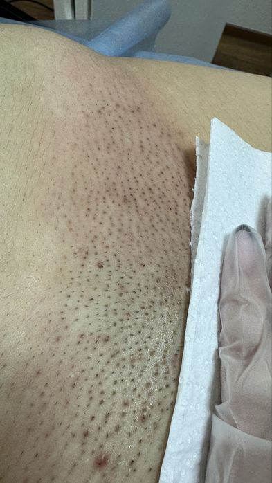 Лазерная эпиляция