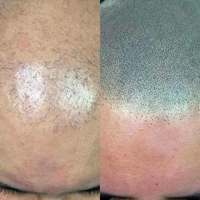 Caut modele pt micro pigmentare SMP scalp chelie / păr rar - tarif mic