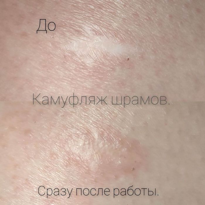 Витилиго камуфляж рубцов