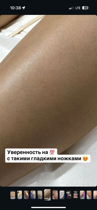 Лазерная эпиляция