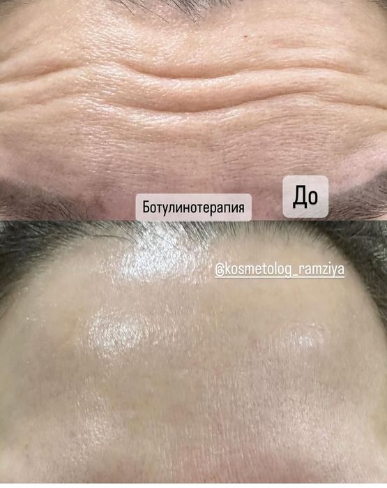Губы, Ботокс, Филлеры