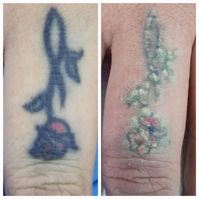 Удаление татуировок любой сложности от 200 тысяч сум