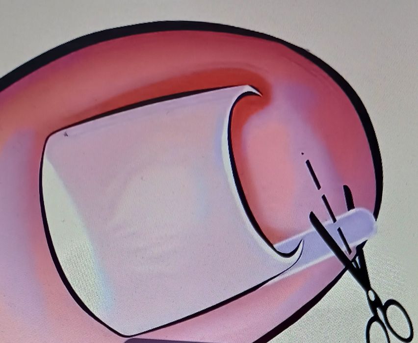 Инструмент за фиксиране и подложки за враснал нокът!