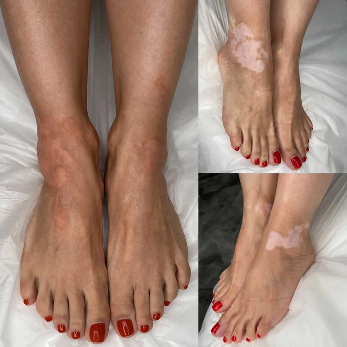 Vitiligo dog'larini kamuflyaj bilan yopish