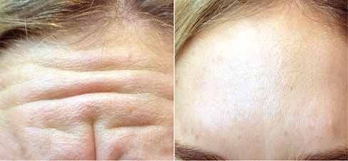 Ботокс,Губы в Ташкенте