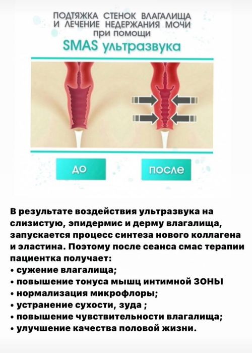 Женское интимное лазерное омоложение