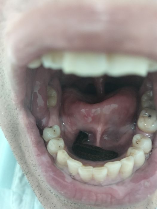 тиббий зулуклар медицинский пиявки гирудотерапия