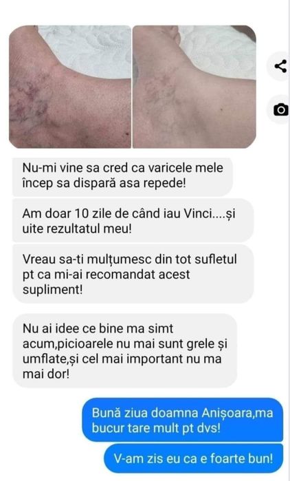 Cum am scăpat eu de durerile de picioare,picioare grele și umflate!