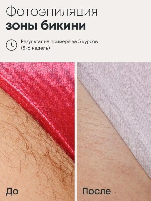 Photoepilator arzon narxda bervoraman