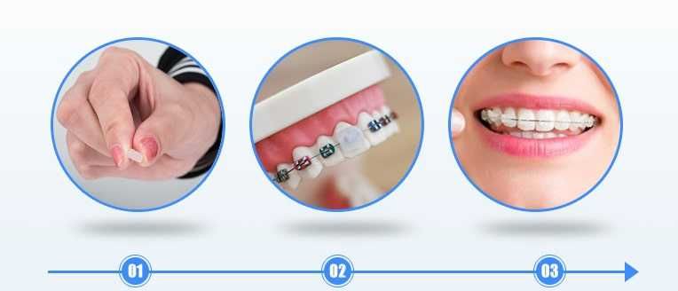 Воск для брекетов