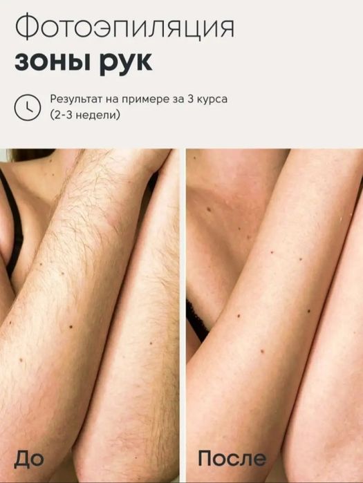 Photoepilator arzon narxda bervoraman