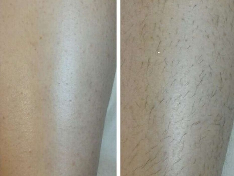 Услуга депиляции качественно и дёшова.