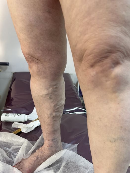 УЗИ (Уздг) сосудов