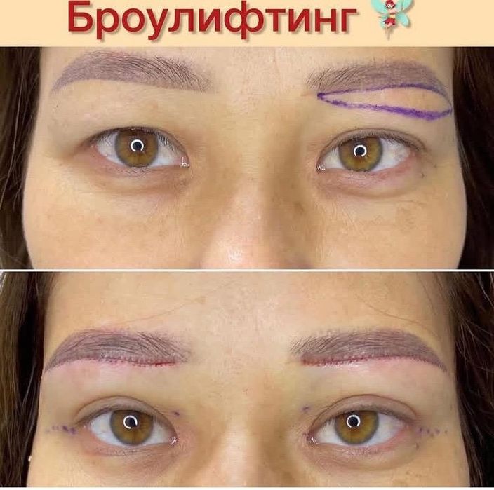 Нитевая блефаропласиика