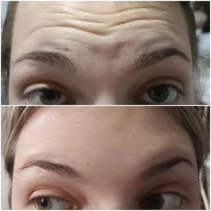 Ботокс | Косметолог Ташкент |